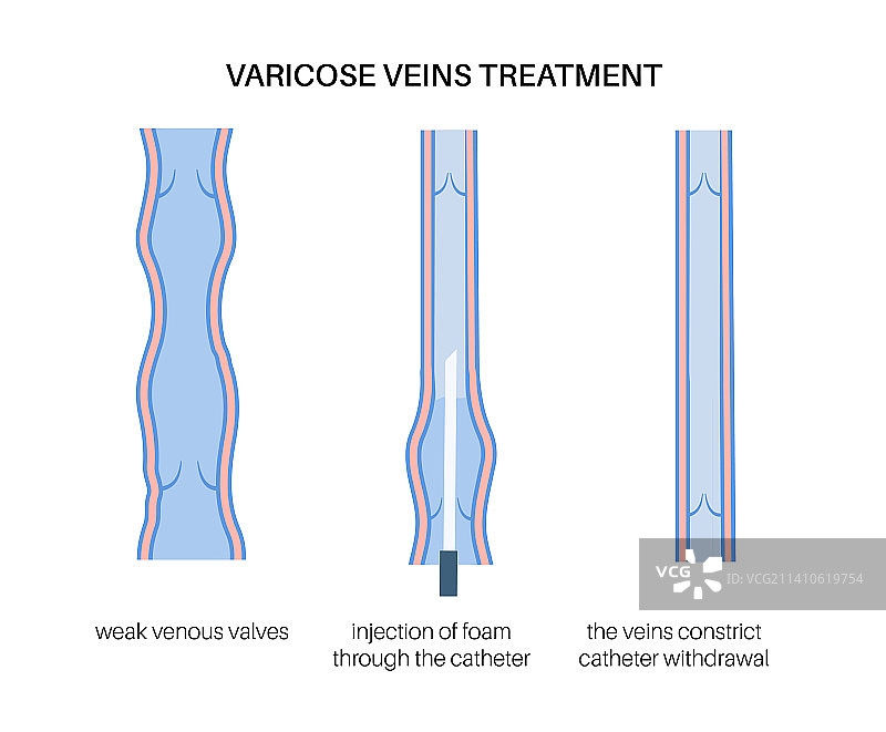静脉曲张治疗图示图片素材