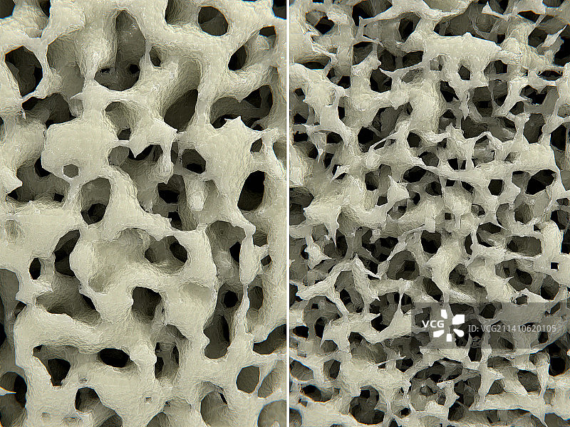 健康的骨骼组织和骨质疏松的骨骼组织插图图片素材