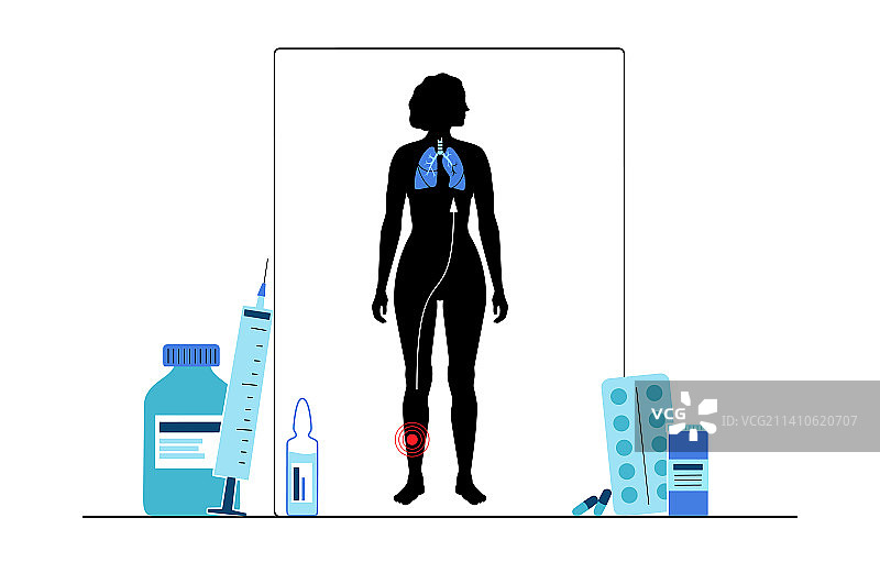 肺栓塞治疗图示图片素材