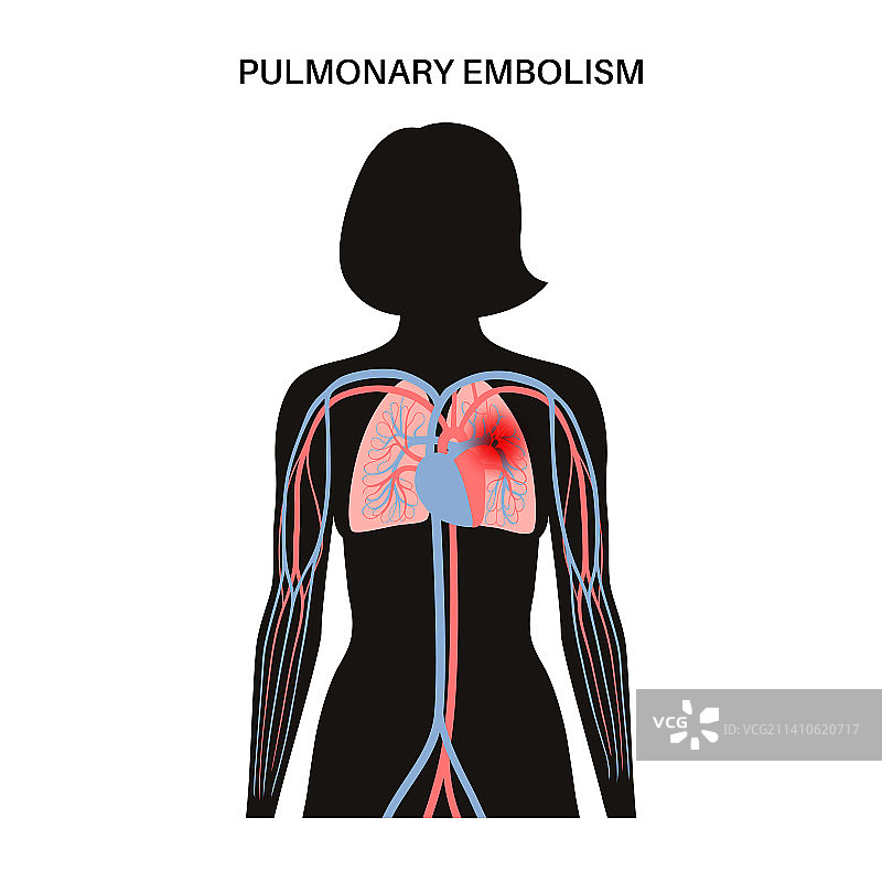 肺栓塞图示图片素材