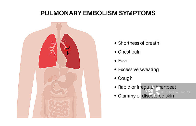 肺栓塞图示图片素材