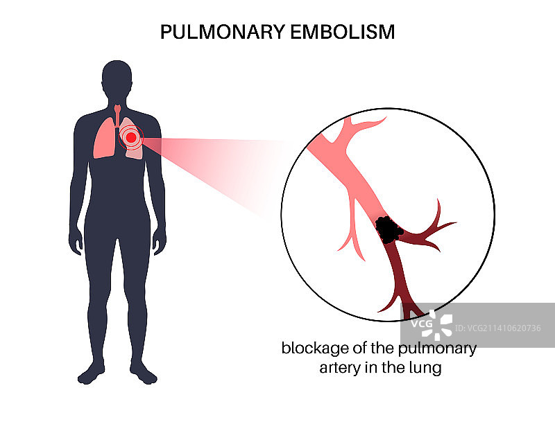 肺栓塞图示图片素材