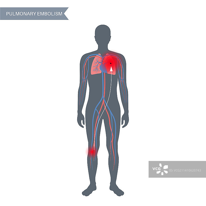 肺栓塞图示图片素材