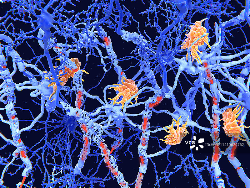 多发性硬化症中的神经损伤图片素材