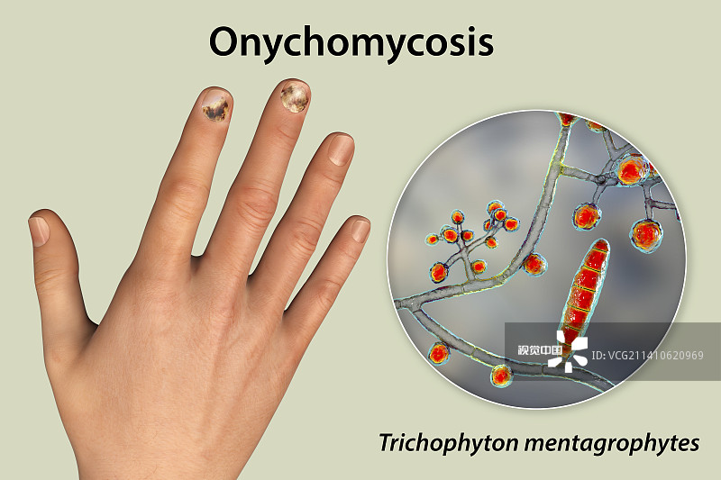 真菌指甲感染，插图图片素材