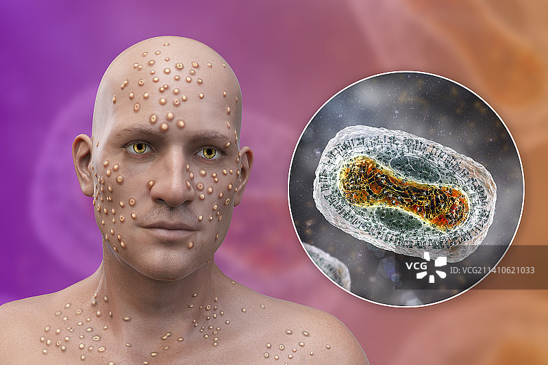 天花病毒感染，图示图片素材