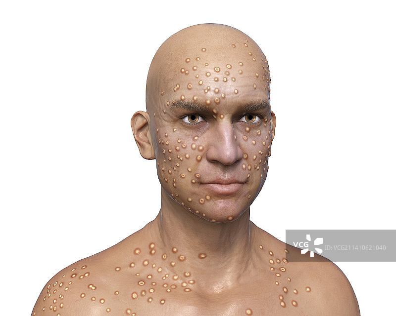 患天花的病人插图图片素材