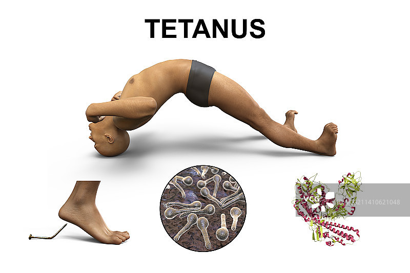 破伤风疾病的机制示意图图片素材