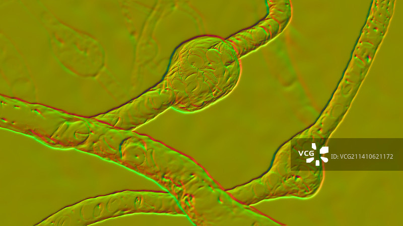 微动脉瘤插图图片素材