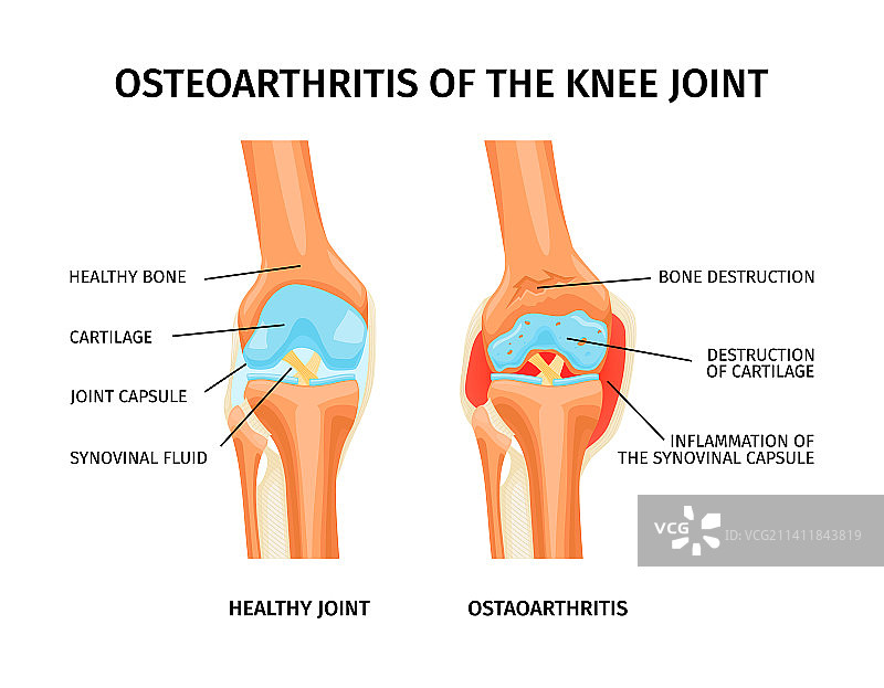 膝关节骨关节炎信息图图片素材