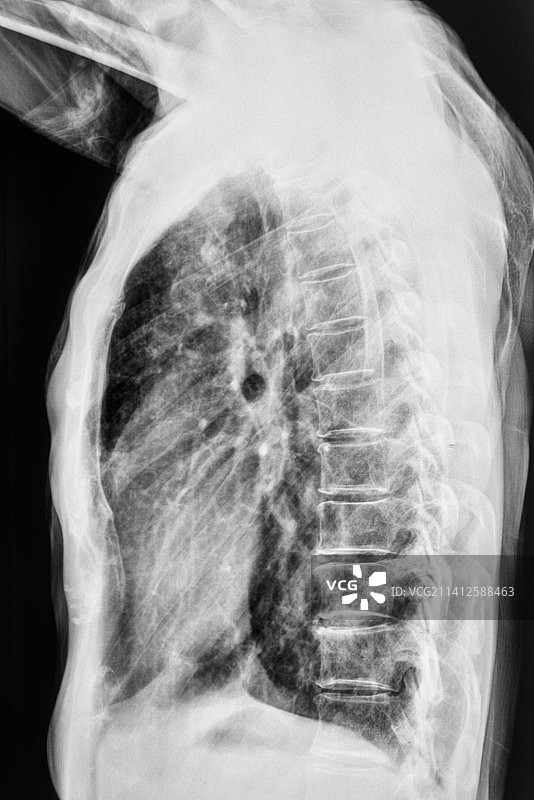 胸部X光成像图片素材