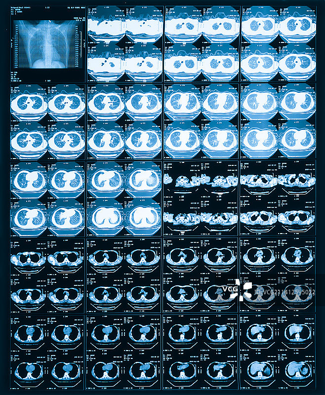 胸部CT影像图片素材