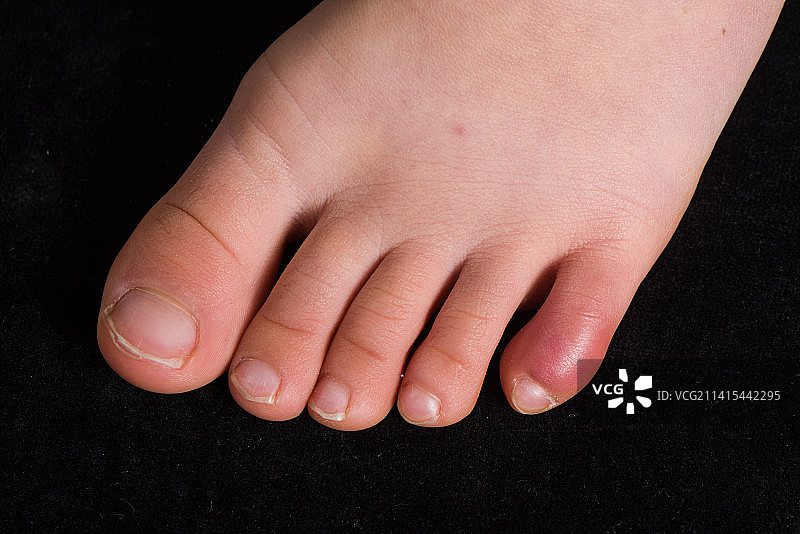 儿童脚趾冻伤得冻疮图片素材