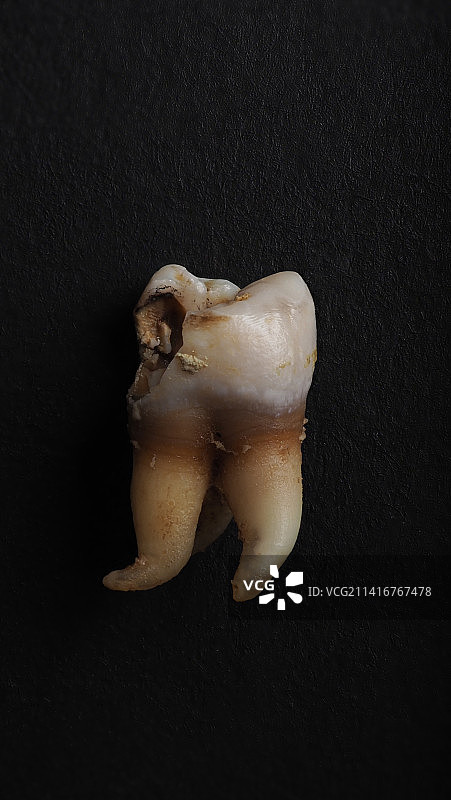 牙医拔牙后腐烂的牙齿，泰国曼谷图片素材