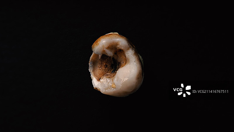 牙医拔牙后腐烂的牙齿，泰国曼谷图片素材