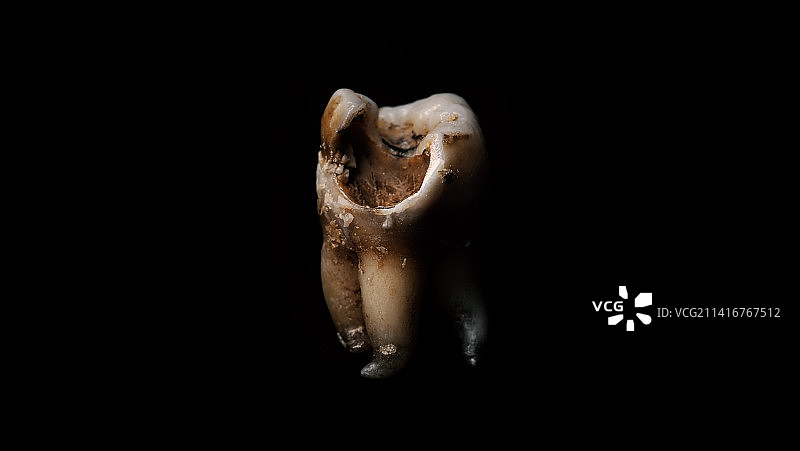 牙医拔牙后腐烂的牙齿，泰国曼谷图片素材