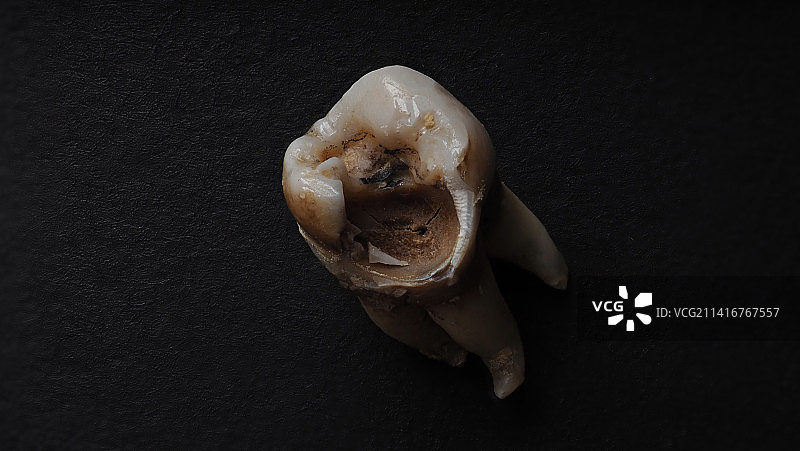 牙医拔牙后腐烂的牙齿，泰国曼谷图片素材