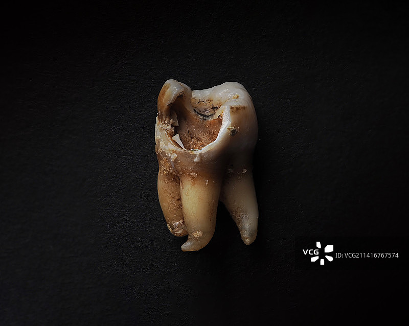 牙医拔牙后腐烂的牙齿，泰国曼谷图片素材