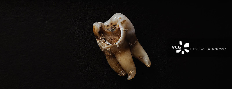 牙医拔牙后腐烂的牙齿，泰国曼谷图片素材