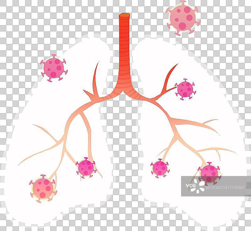 病毒入侵肺部产生白肺疾病医疗元素图片素材