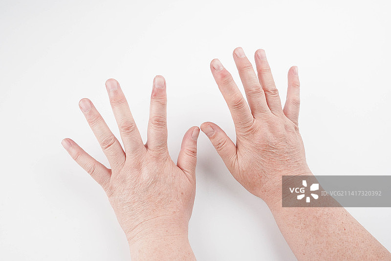 水肿浮肿图片素材