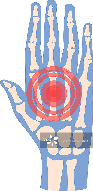 手部疼痛图标卡通关节炎图片素材