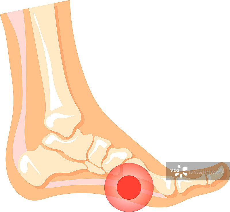 人类足部腿痛红点医疗图片素材
