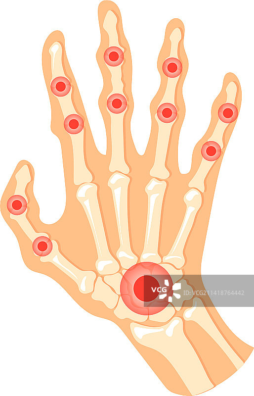 手部关节疼痛红点示意图片素材