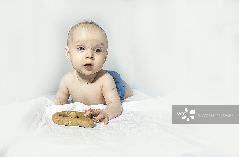 颈部有血管瘤的宝宝躺在白色背景上图片素材