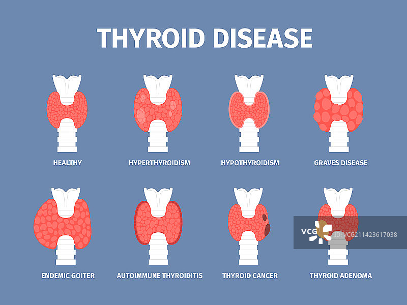 甲状腺疾病与甲状腺肿大图片素材