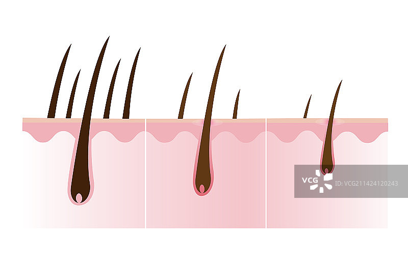 脱发步骤图片素材