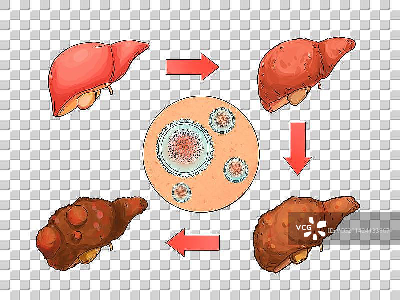 肝病变科普插画图片素材