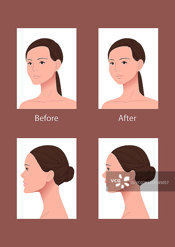 女士面部医疗美容对比图图片素材