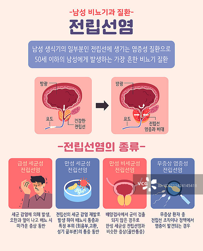 男性泌尿系统疾病与前列腺图片素材