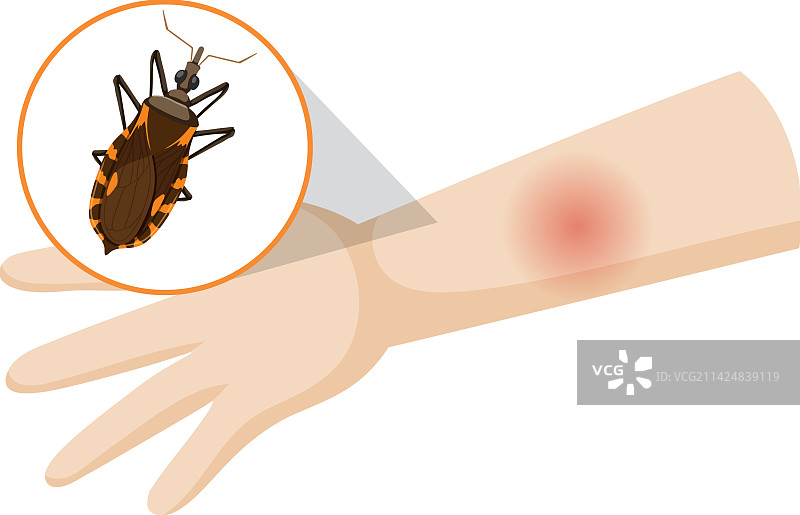 被锥虫叮咬后肿胀的人类手臂图片素材