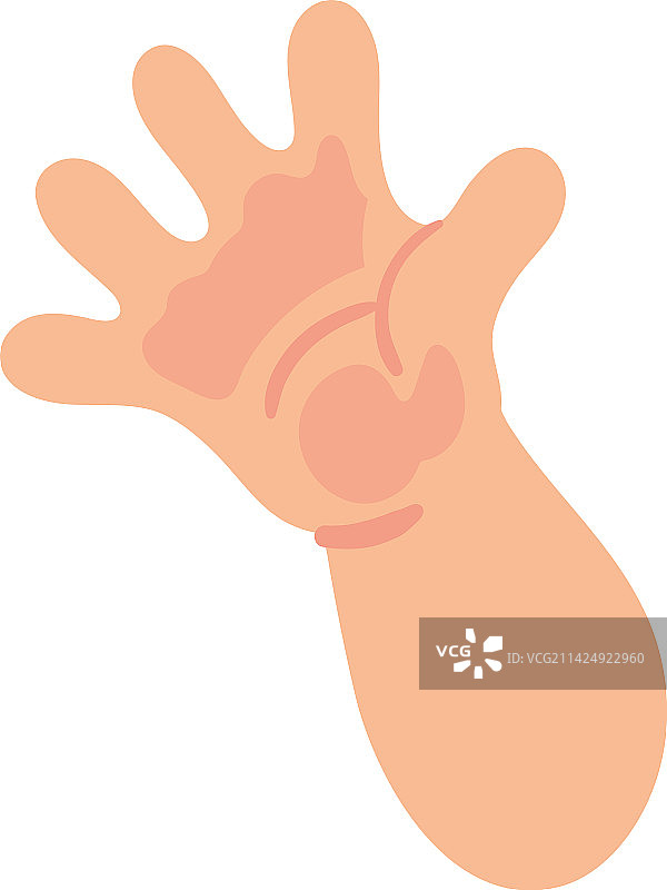 唐氏综合征的手图片素材