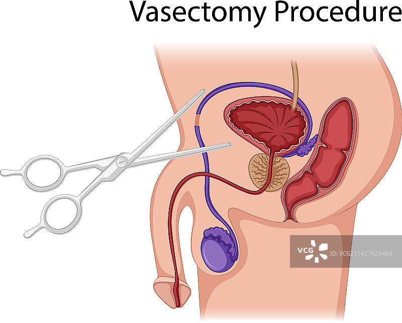 输精管结扎手术图解图片素材