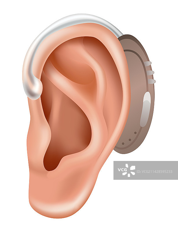 用于听力障碍患者的助听器图片素材
