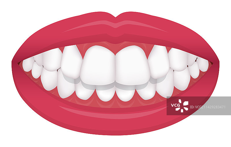 牙齿咬合问题：牙齿不齐和深覆合图片素材