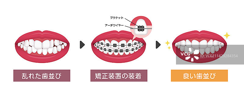 牙齿矫正过程（日式）图片素材