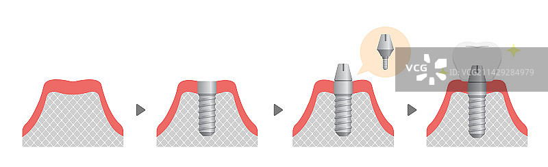 牙科植入过程（扁平风格，无文字）图片素材