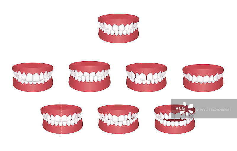牙齿问题咬合类型集合图片素材