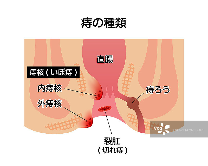 痔疮类型扁平风格插画图片素材