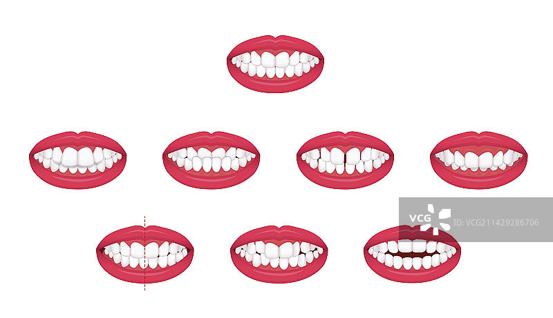 牙齿咬合问题：牙齿不齐图片素材