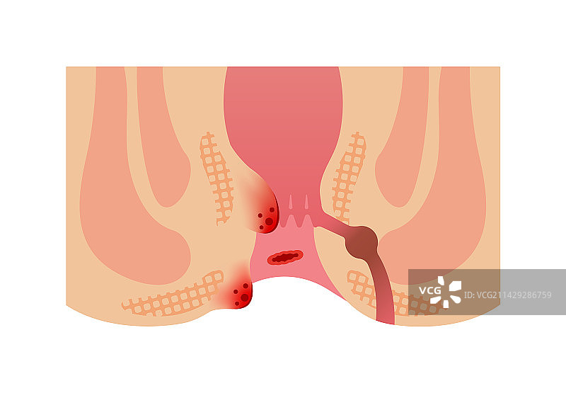 痔疮类型图示（无文字）图片素材
