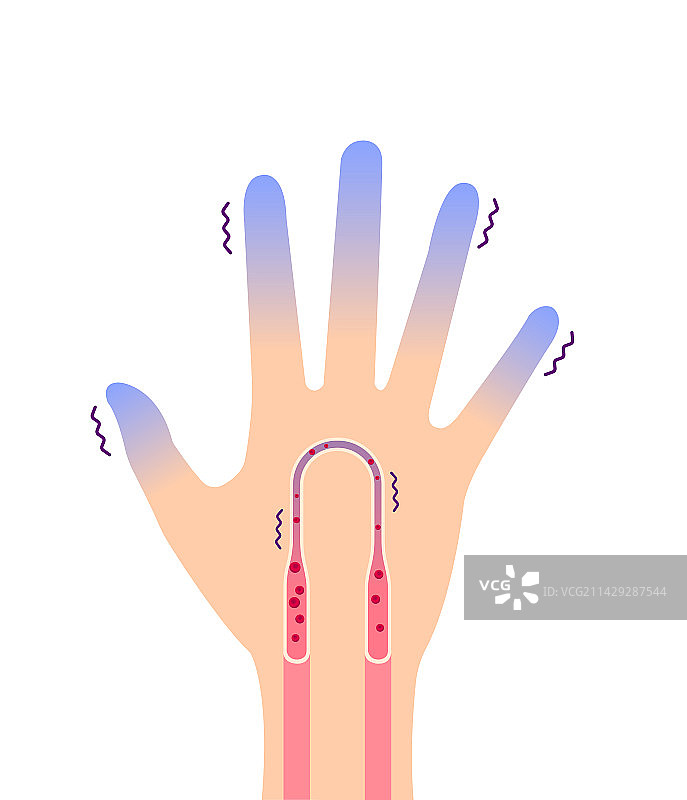 手冷血液循环对寒冷敏感图片素材