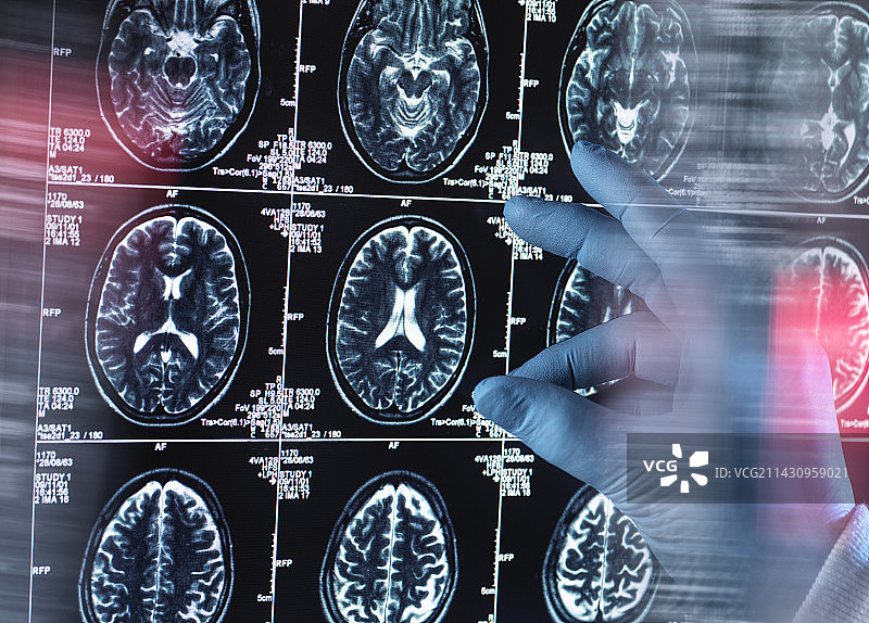 神经内科诊断概念图图片素材