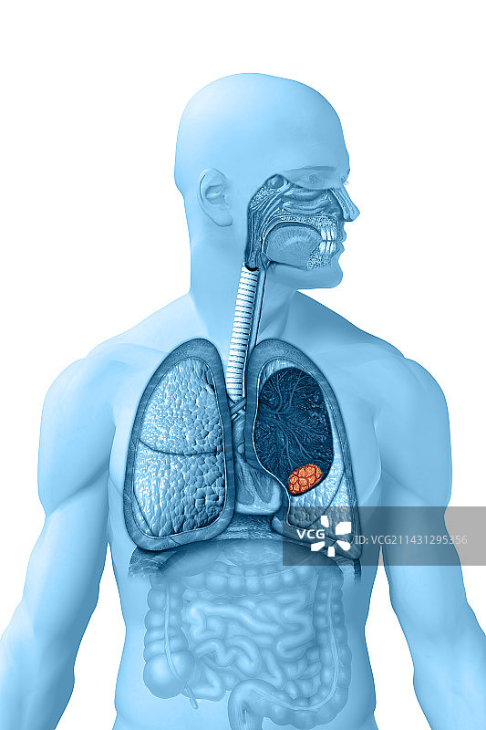 肺癌图示图片素材