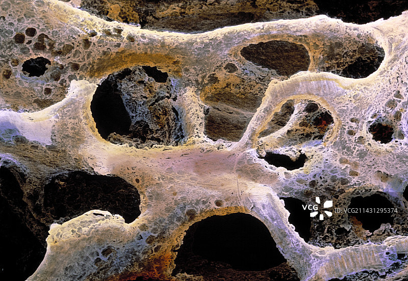 骨质疏松骨骼的扫描电子显微镜图片素材