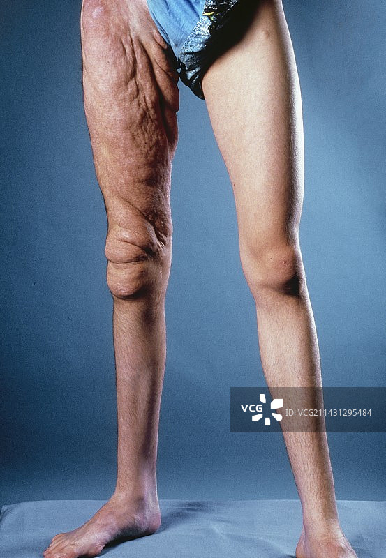 大腿患有神经纤维瘤的男人图片素材